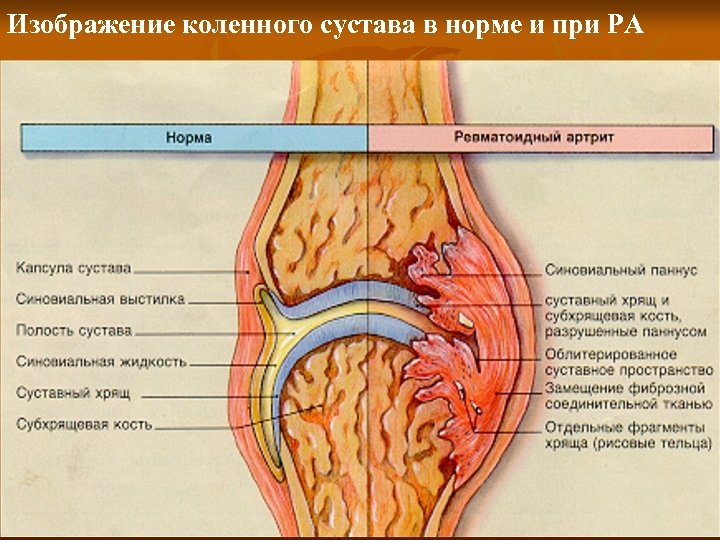 Изображение коленного сустава в норме и при РА 