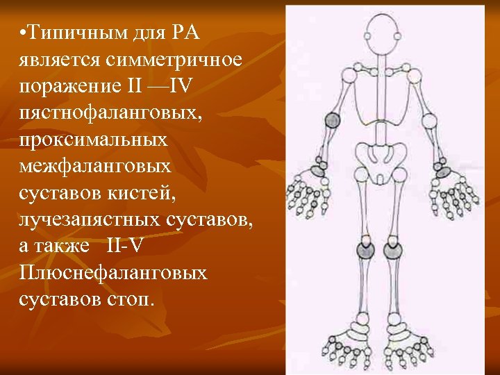  • Типичным для РА является симметричное поражение II —IV пястнофаланговых, проксимальных межфаланговых суставов
