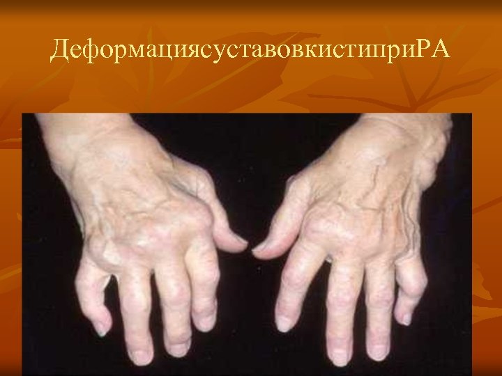 Деформациясуставовкистипри. РА 