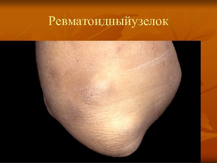 Ревматоидныйузелок 