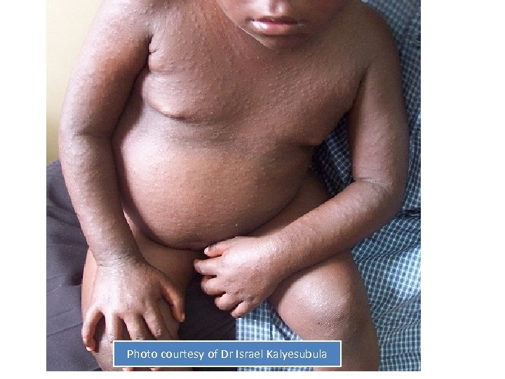 Photo courtesy of Dr Israel Kalyesubula 