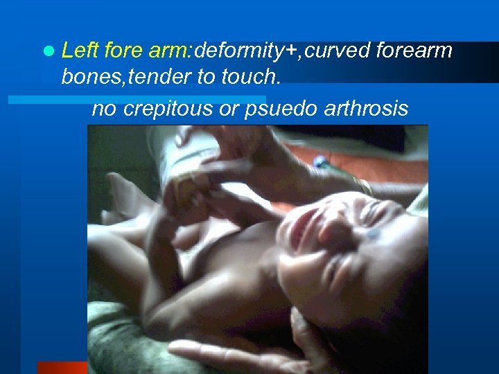 l Left fore arm: deformity+, curved forearm bones, tender to touch. no crepitous or