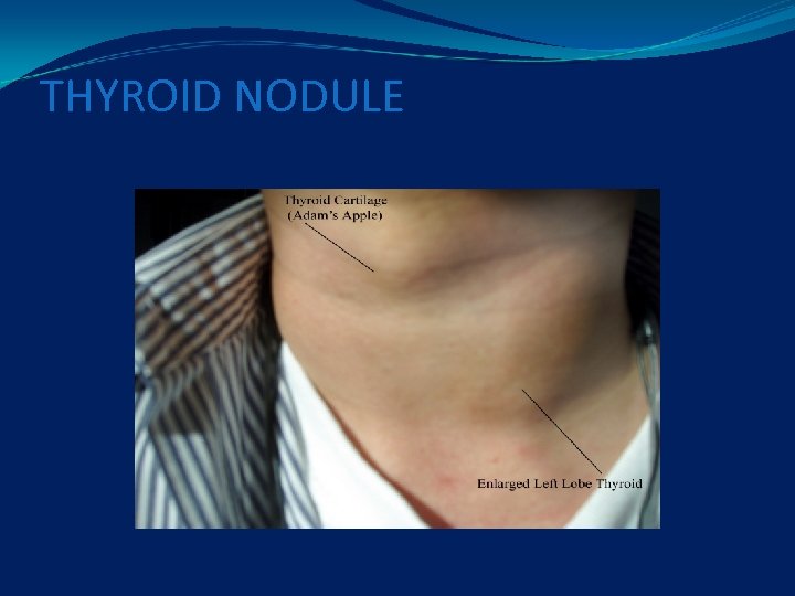 THYROID NODULE 