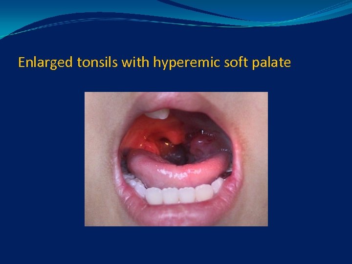 Enlarged tonsils with hyperemic soft palate 