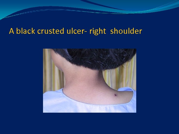 A black crusted ulcer- right shoulder 