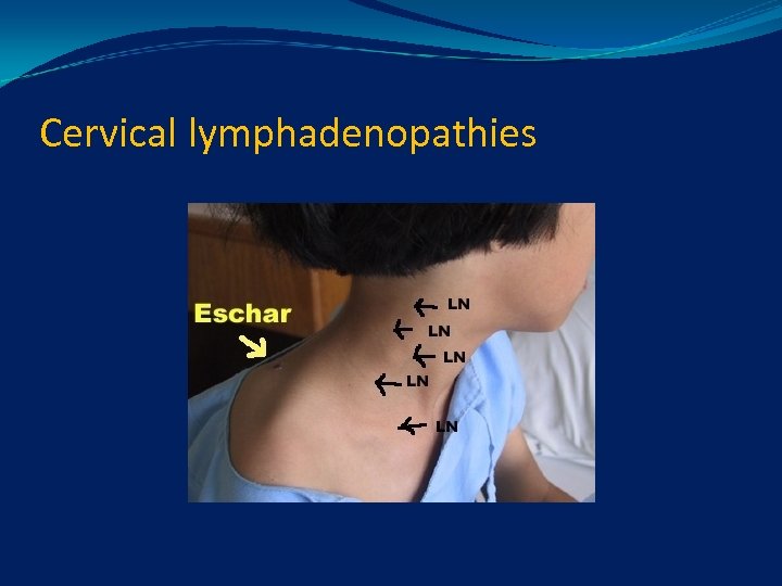 Cervical lymphadenopathies 