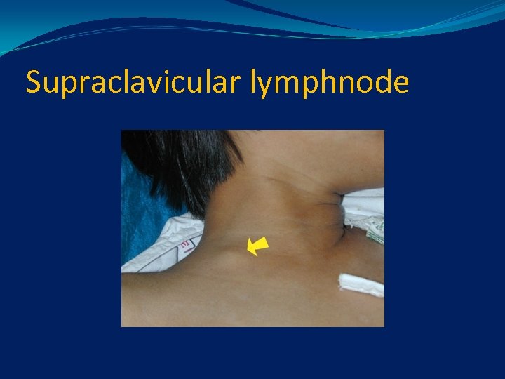 Supraclavicular lymphnode 