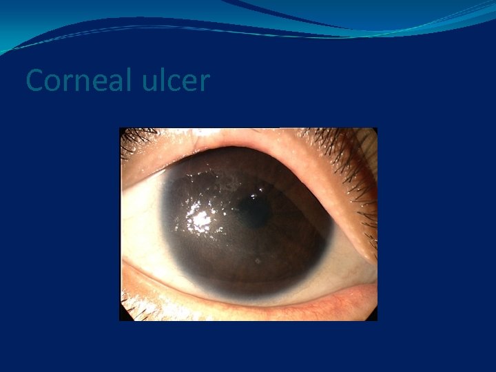 Corneal ulcer 