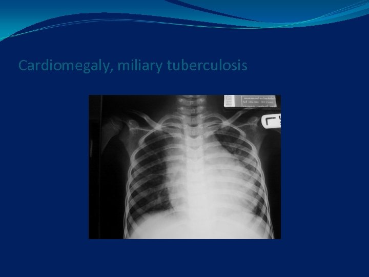 Cardiomegaly, miliary tuberculosis 