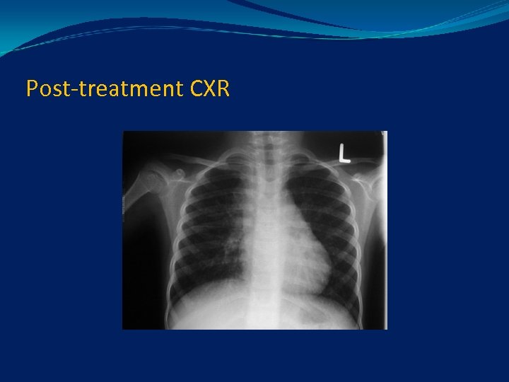 Post-treatment CXR 