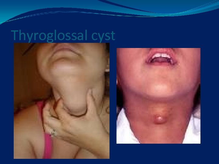 Thyroglossal cyst 