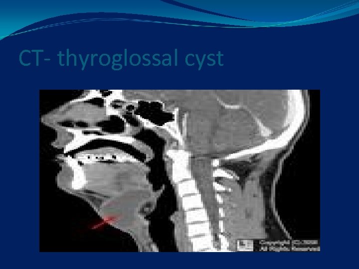 CT- thyroglossal cyst 