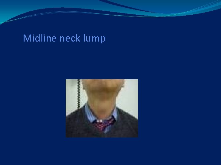 Midline neck lump 