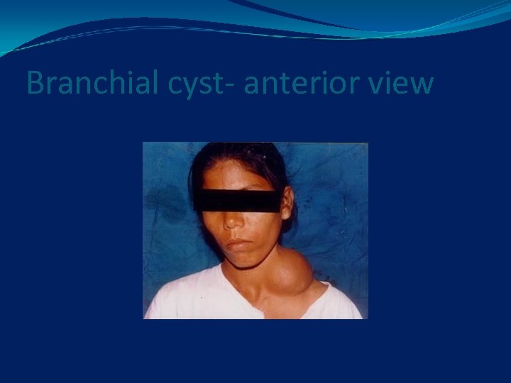 Branchial cyst- anterior view 