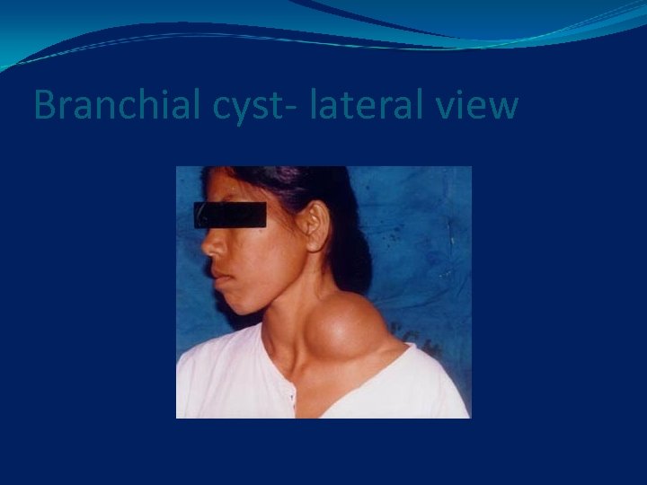 Branchial cyst- lateral view 