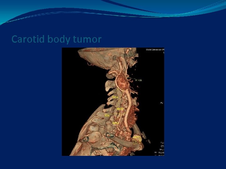 Carotid body tumor 