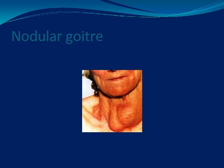 Nodular goitre 