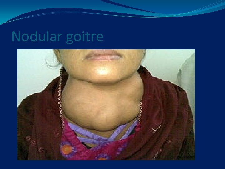 Nodular goitre 