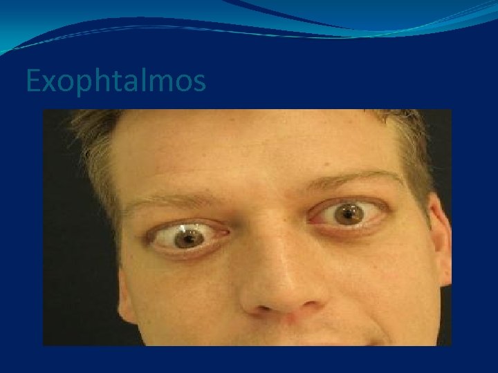 Exophtalmos 