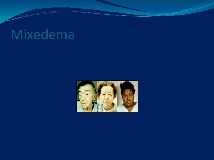 Mixedema 