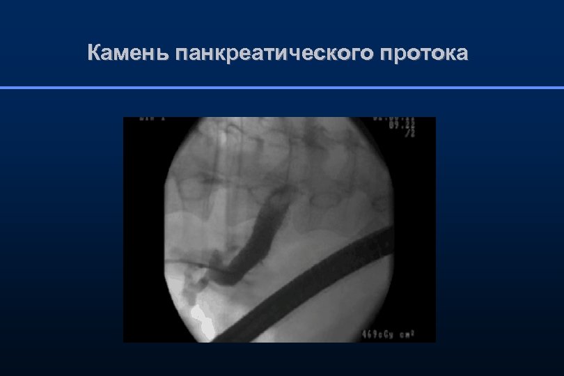 Камень панкреатического протока 