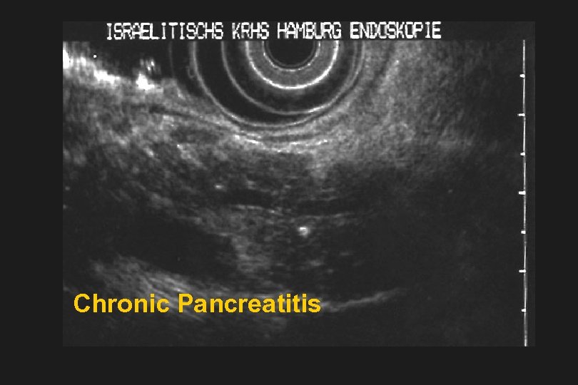 Chronic Pancreatitis 