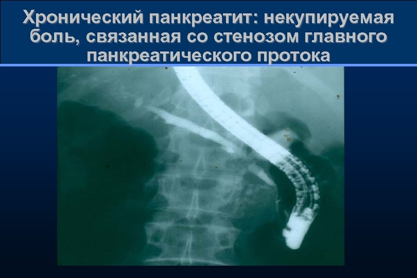 Хронический панкреатит: некупируемая боль, связанная со стенозом главного панкреатического протока 