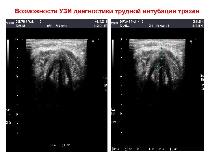 Возможности УЗИ диагностики трудной интубации трахеи 