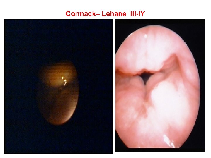 Cormack– Lehane III-IY 