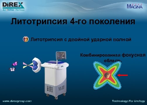Литотрипсия 4 -го поколения Литотрипсия с двойной ударной волной Комбинированная фокусная область 
