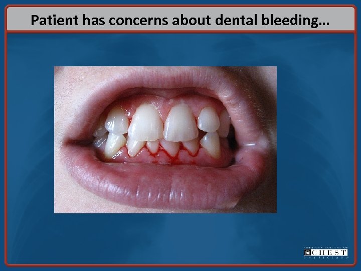 Patient has concerns about dental bleeding… 