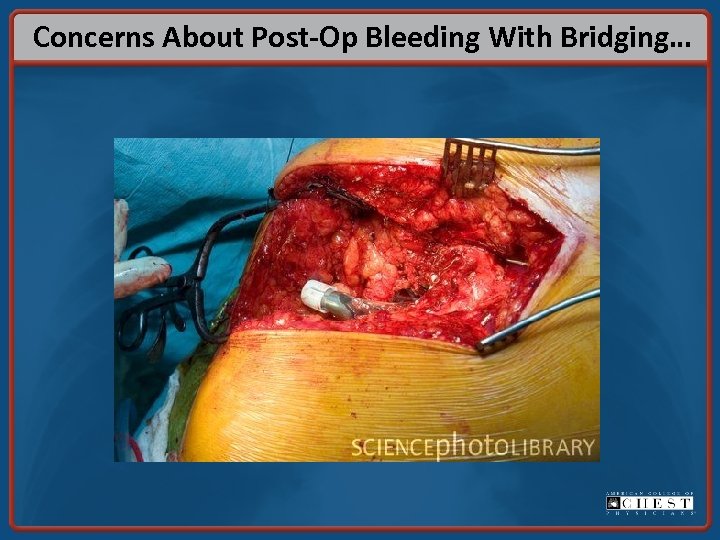 Concerns About Post-Op Bleeding With Bridging… 