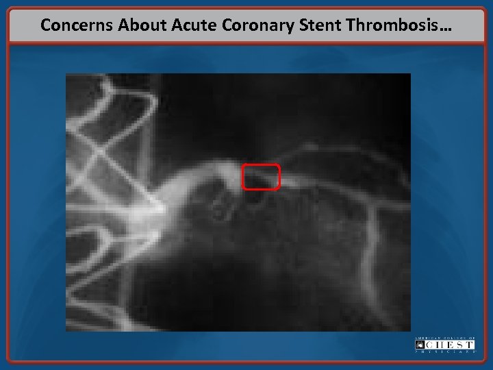 Concerns About Acute Coronary Stent Thrombosis… 