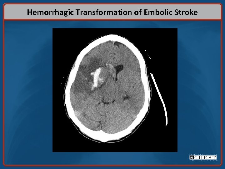 Hemorrhagic Transformation of Embolic Stroke 