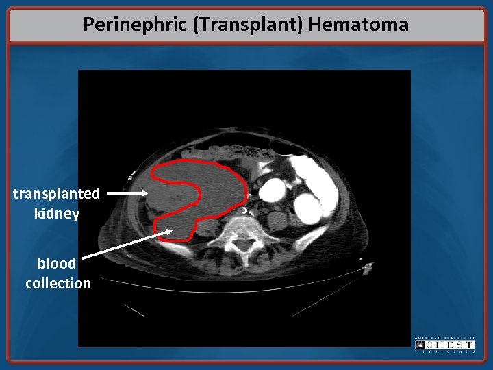 Perinephric (Transplant) Hematoma transplanted kidney blood collection 