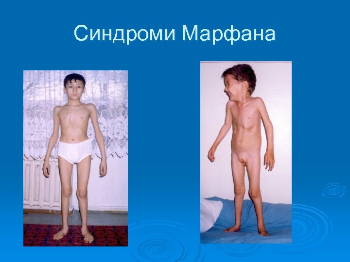 Синдроми Марфана 