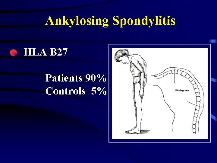 Ankylosing Spondylitis HLA B 27 Patients 90% Controls 5% 