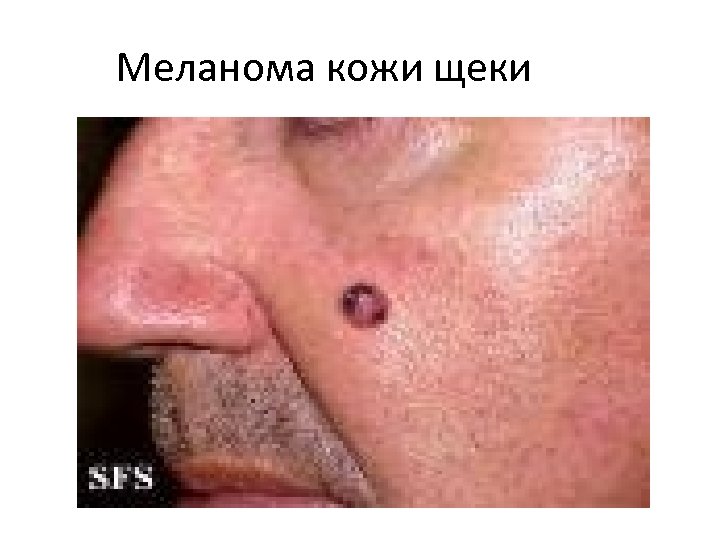 Меланома кожи щеки 
