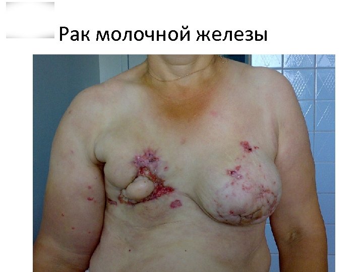 Рак молочной железы 