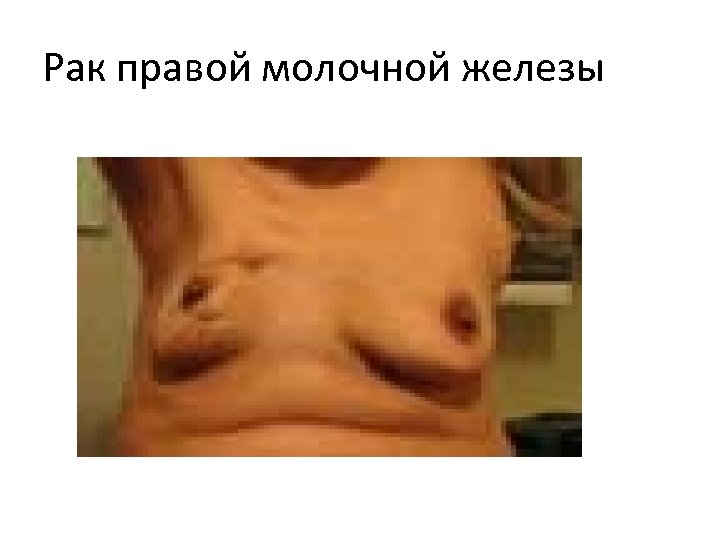 Рак правой молочной железы 