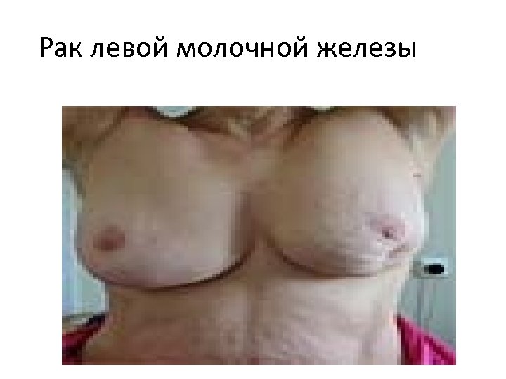 Рак левой молочной железы 
