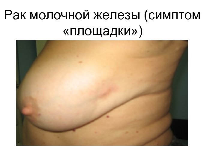 Рак молочной железы (симптом «площадки» ) 