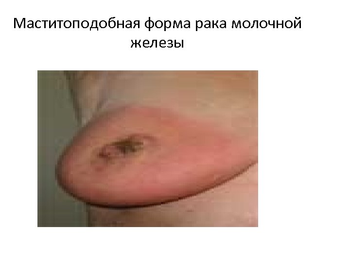 Маститоподобная форма рака молочной железы 