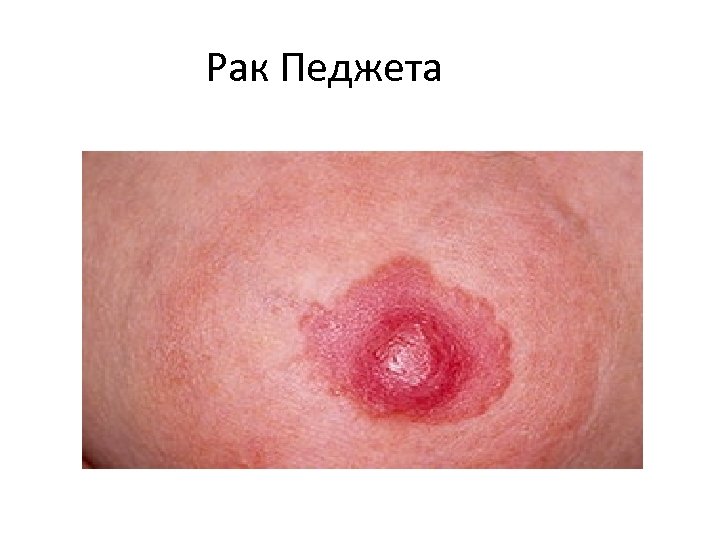 Рак Педжета 