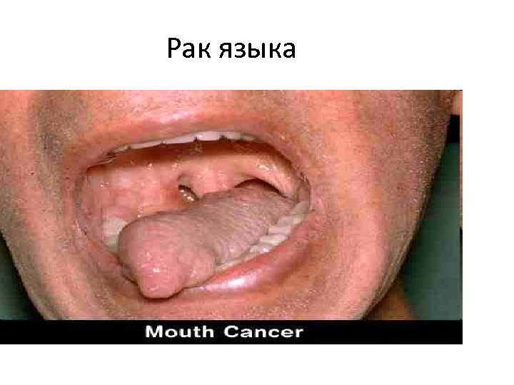 Рак языка 