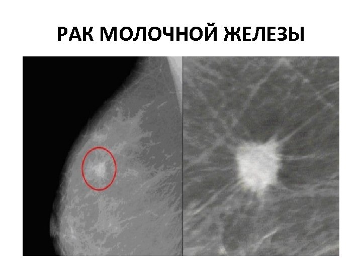 РАК МОЛОЧНОЙ ЖЕЛЕЗЫ 