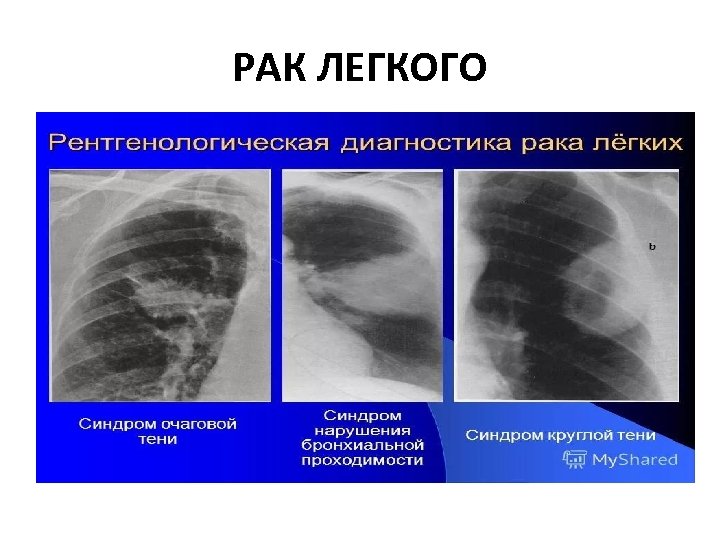 РАК ЛЕГКОГО 