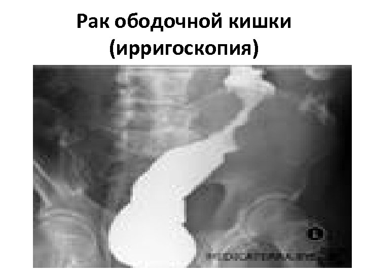 Рак ободочной кишки (ирригоскопия) 