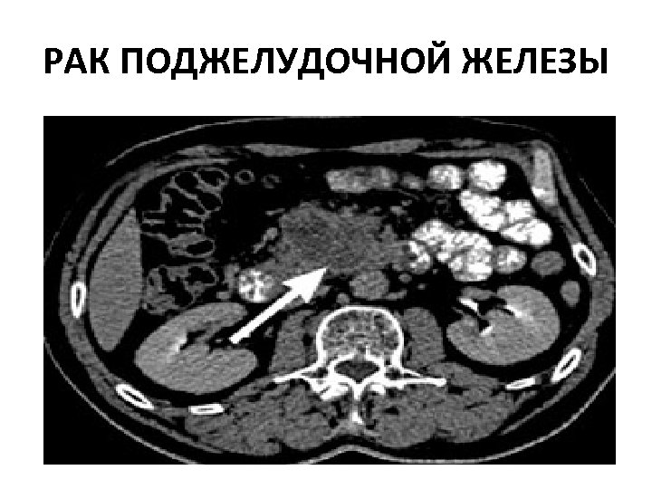 РАК ПОДЖЕЛУДОЧНОЙ ЖЕЛЕЗЫ 