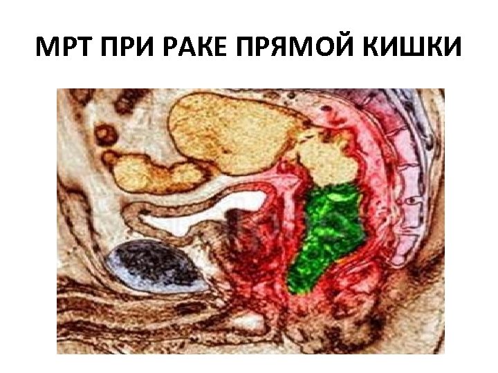 МРТ ПРИ РАКЕ ПРЯМОЙ КИШКИ 